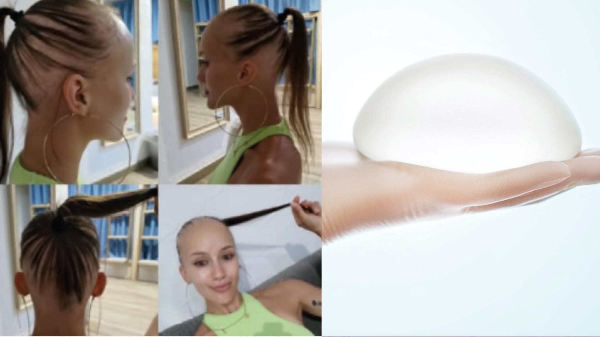 Una joven se operó el busto y se quedó sin cabello y pestañas ¿qué pasó?